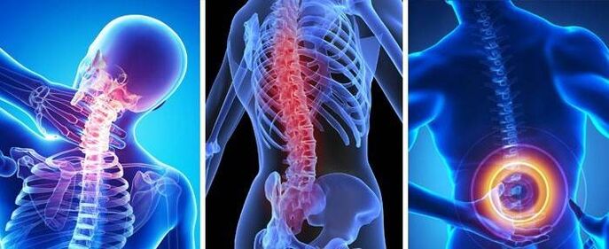 cum să tratați osteocondroza coloanei vertebrale toracice tratamentul condrozei coloanei lombare